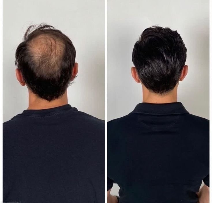 Explore Hair Restoration